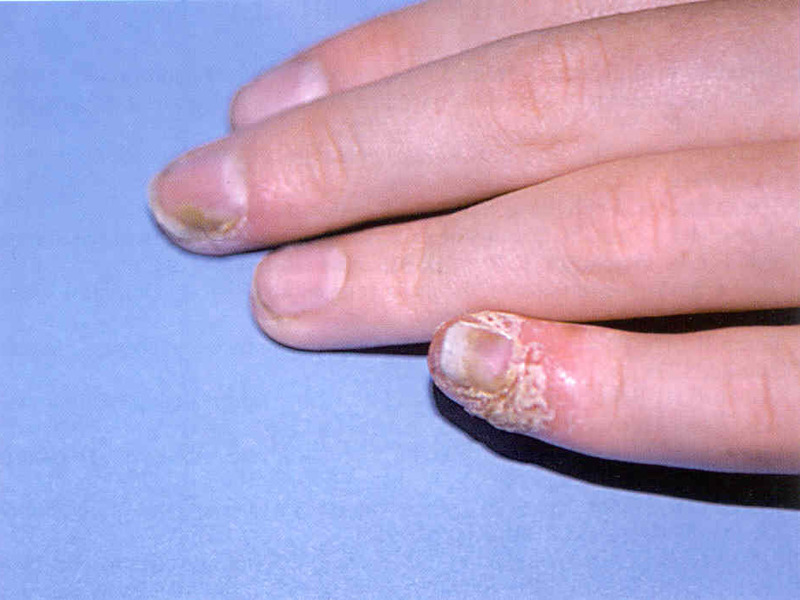 Грибковое заболевание пальцев