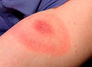 Аллергия на укус насекомого