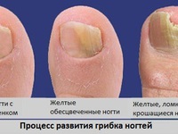 Грибок на ногтях - это заболевание, которым может заразиться человек в общественных местах.