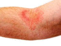 Аллергия может проявляться в том числе сыпью на коже.
