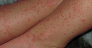 Контактный дерматит возникает по причине контактов кожных покровов с химически активными или другими вредными веществами.
