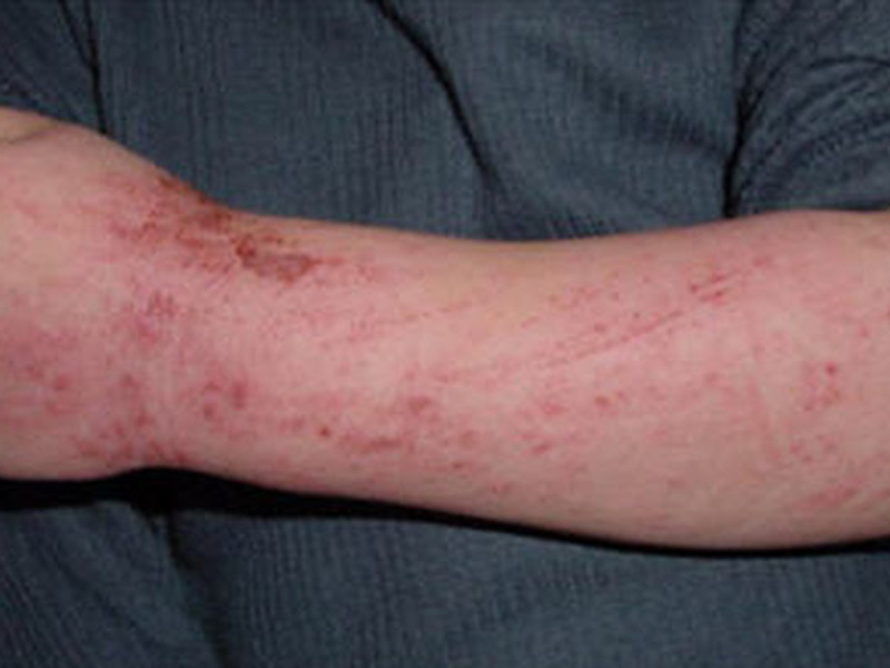 Атопический дерматит проявляется, прежде всего, сыпью.