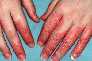 Обострение дерматита возникает при неблагоприятных условиях и воздействии вредных веществ на кожу.