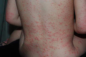 Аллергическая сыпь у ребенка - как она выглядит?