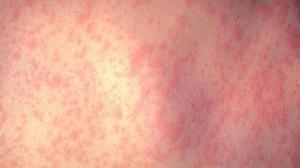 Сыпь на коже ребенка может быть вызвана разными причинами.