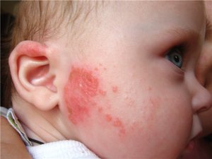 Аллергические кожные реакции у малышей  возникают на фоне самых разных раздражителей.