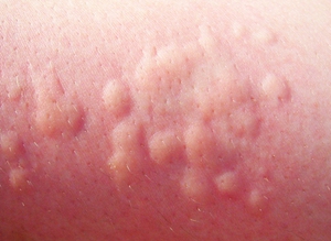 Крапивница - это острая аллергическая реакция на коже ребенка.