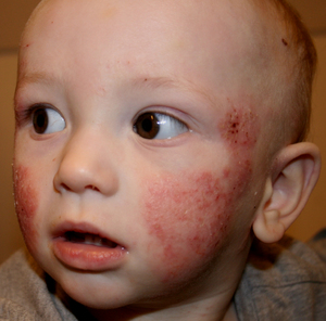 Детский дерматит на лице