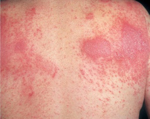 Заболевание кожи дерматит