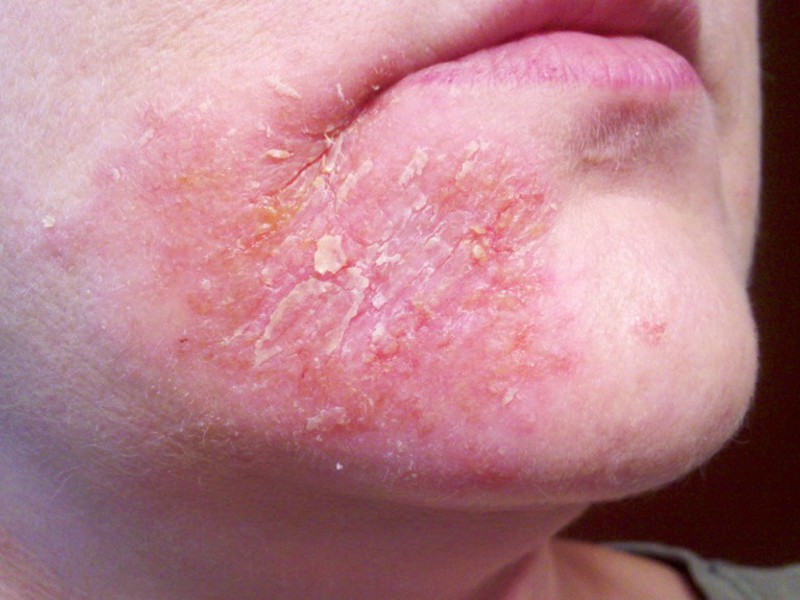 Причины появления дерматита на коже