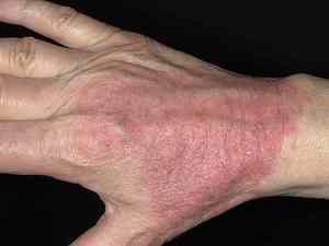 Атопический дерматит появляется на руках очень часто.