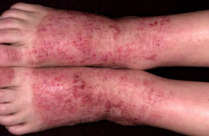 Атопический дерматит на лодыжках также частое явление.
