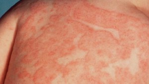 Симптомы дерматита включают в себя сыпь, зуд, высыхание кожи.