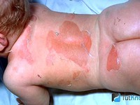 Пеленочный дерматит появляется у младенцев.