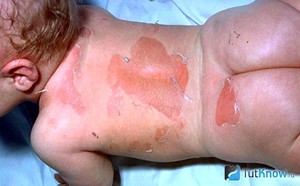 Пеленочный дерматит появляется у младенцев.