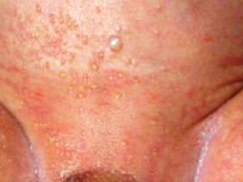 В числе симптомов пеленочного дерматита наиболее заметна сыпь на коже. 