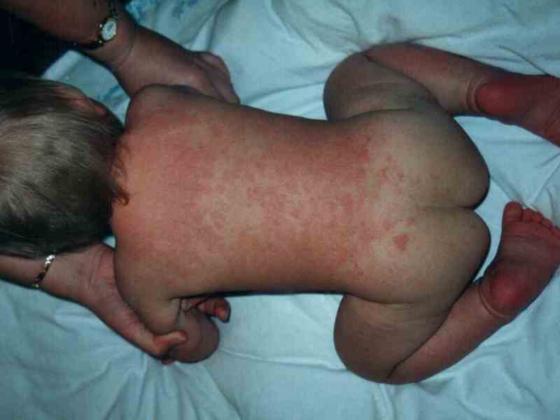 Как избавиться от дерматита у грудного ребенка?