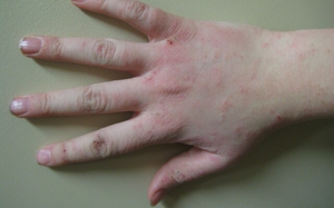 Аллергический дерматит может быть почти незаметным, но если появляется сыпь, надо обращать внимание на проблему.