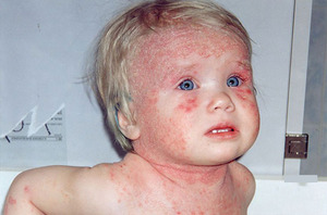 Почему у ребенка появился атопический дерматит и почему его нужно вовремя лечить?