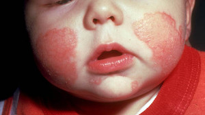 Дерматит на лице у малыша проявляется очень ярко.