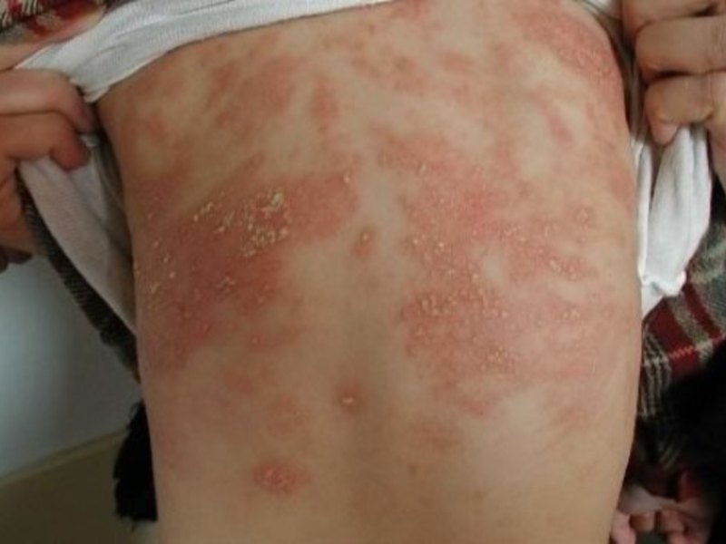 Атопический дерматит может появляться у малышей при заболеваниях ЖКТ.