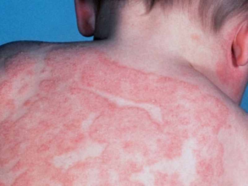 Атопический дерматит на спине у ребенка показан на фото.