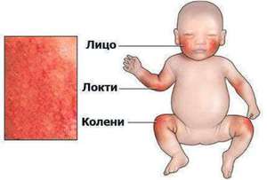 Где бывает дерматит у малышей - наглядная схема.