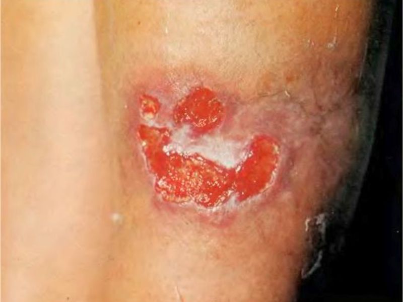 Почему появилось заболевание туберкулез кожи