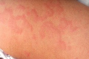 Инфекция, аллергия или другие заболевания