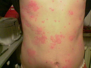 Рецидивирующая крапивница  - одна из форм этого аллергического заболевания кожи.