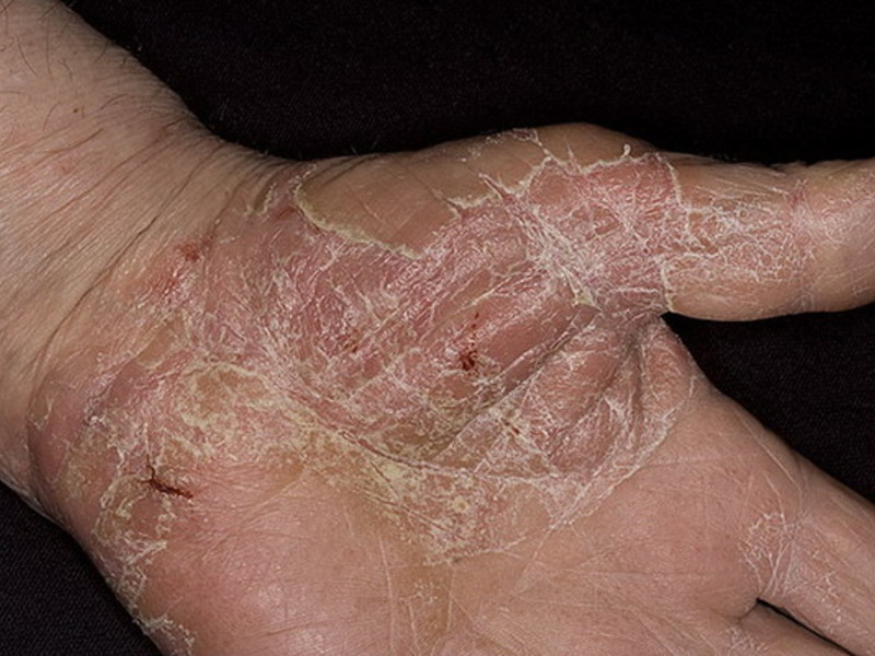 Шелушение кожи на ладонях также может быть следствием аллергии.