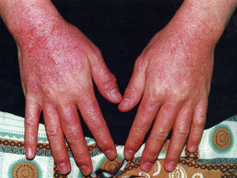 Контактная аллергия возникает после того, как кожа побывала в контакте с веществом-аллергеном.