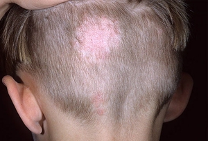Первые признаки лишая стригущего - это появление пятна на коже и выпадение на этом пятне волос.