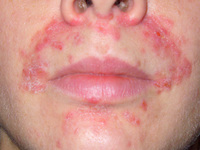 Как лечится дерматит на лице