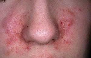Как вылечить дерматит на лице