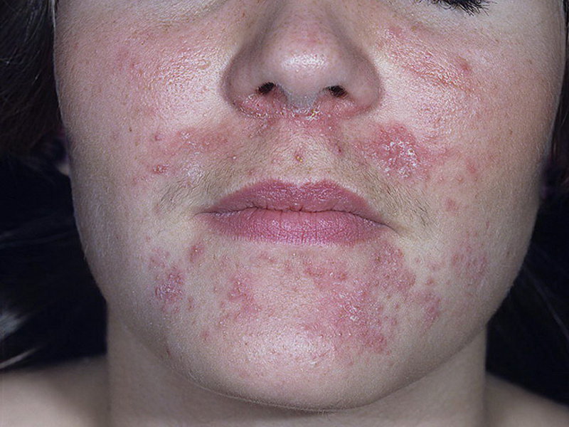 Виды дерматита на лице