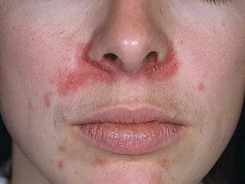 периоральный дерматит фото на лице у женщин фото Новым годом