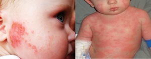 Как вылечить ребенка от аллергической сыпи