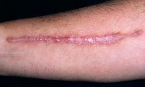 Гранулема на рубце - фото послеоперационного шрама.