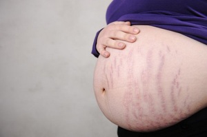 Растяжки часто возникают на последних месяцах беременности.