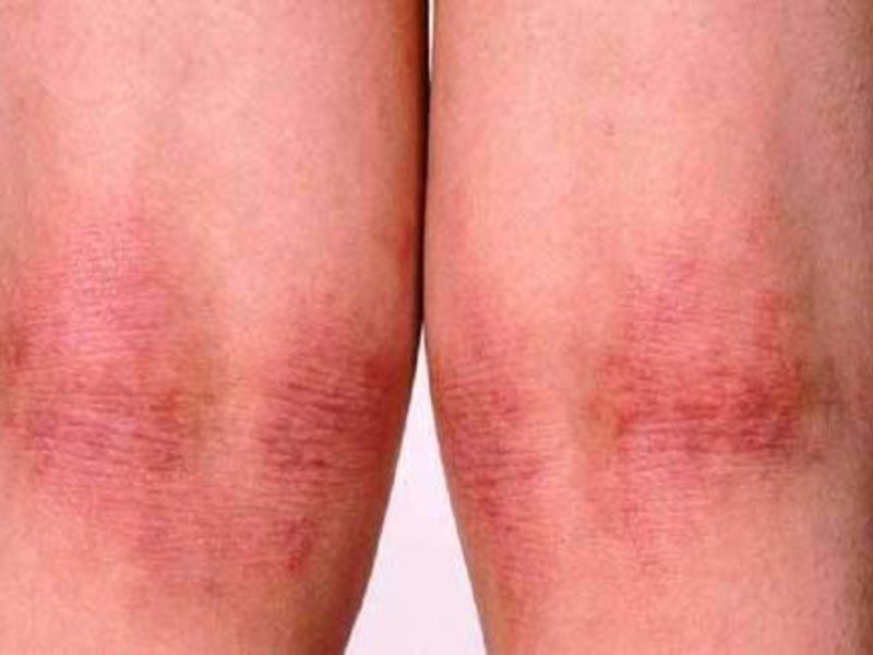 Диагностика дерматита на ногах