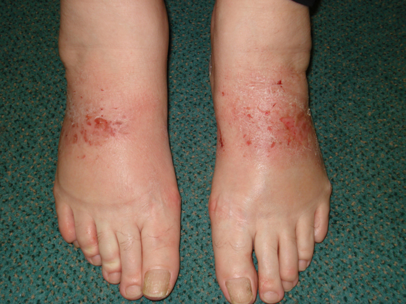 Как вылечить дерматит на ногах