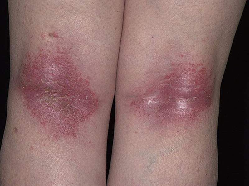 Способы лечения дерматита на ногах