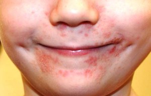 Пероральный дерматит у ребенка показан на фото.