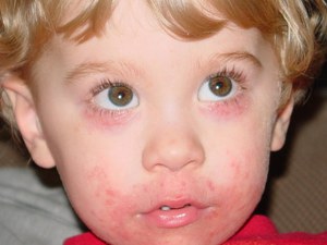 Периоральный дерматит  у маленьких детей может развиваться очень быстро.