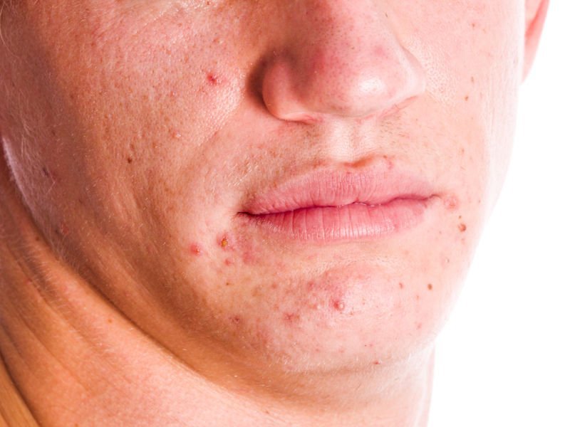 Как проявляется заболевание кожи