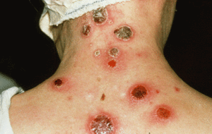 Симптомами сифилиса могут быть, в том числе, язвы на коже.