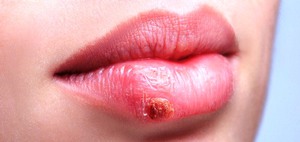 Герпес на губе - распространенная болезнь.