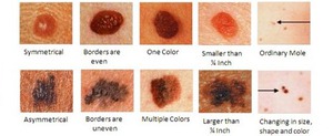 Меланома - это кожное заболевание, относящееся к новообразованиям.