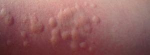 Аллергическая крапивница также вызывает зуд, но эта болезнь не заразна.